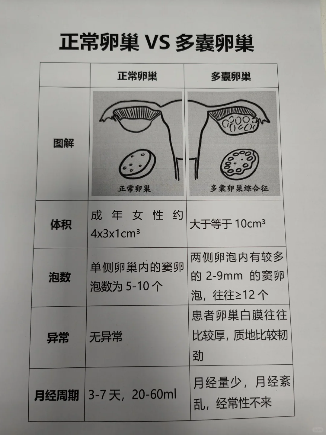 多囊卵巢与正常卵巢的差异解析