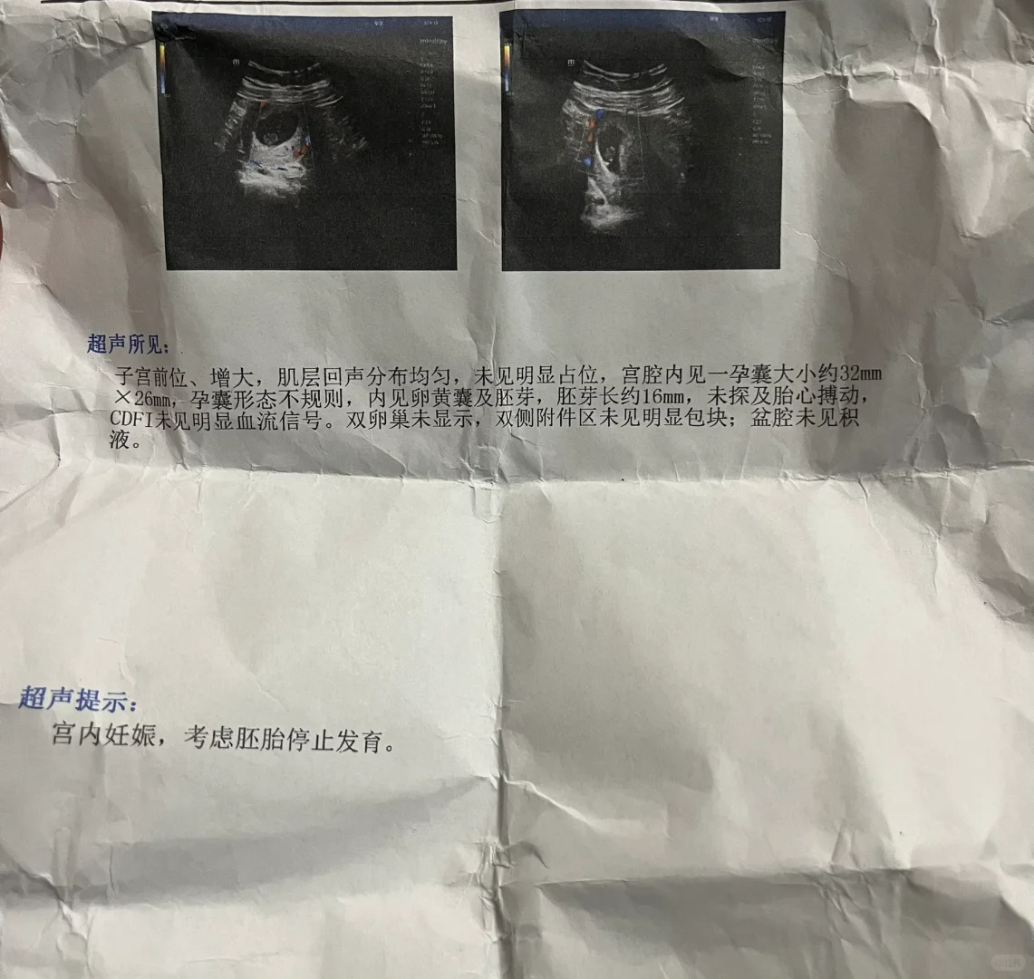 多囊促排停黄体酮致8周胎停的警示与经验分享